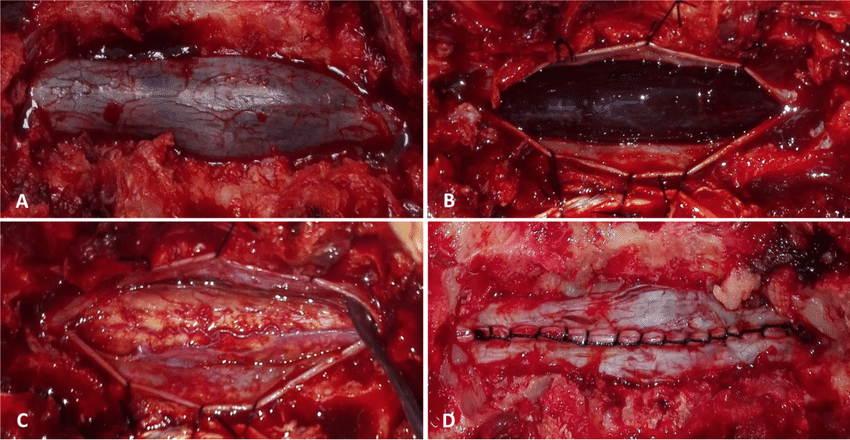 A-Per-operative-image-showing-bluish-bulging-dura-with-underlying-hematoma-B-Dura-is
