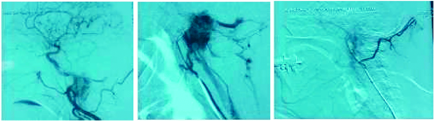 Digital-subtraction-angiography-was-performed-for-diagnosis-and-to-guide-preoperative
