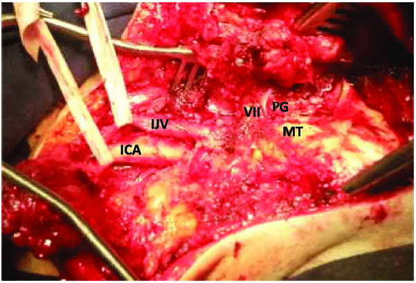 The-sternocleidomastoid-muscle-is-mobilized-posterioinferiorly-and-the-digastric-muscle
