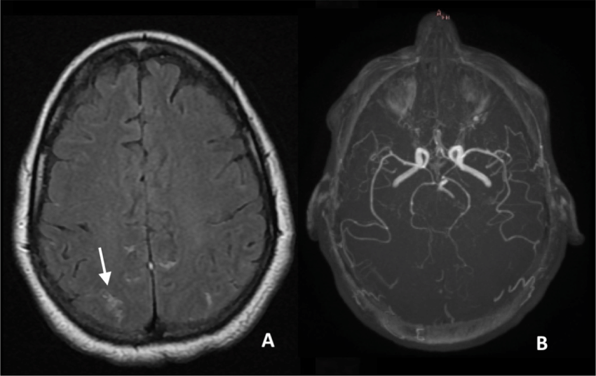 Brain-magnetic-resonance-imaging-MRI-and-magnetic-resonance-angiography-MRA-on