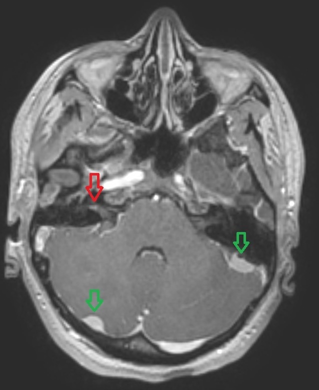 NF21