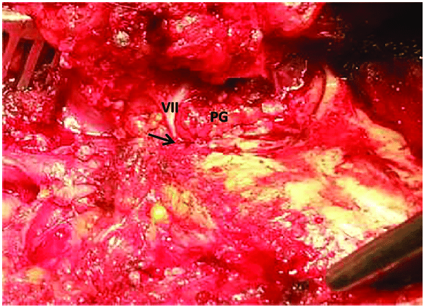 The-facial-nerve-VII-is-exposed-distally-as-it-enters-the-parotid-gland-PG-from-the