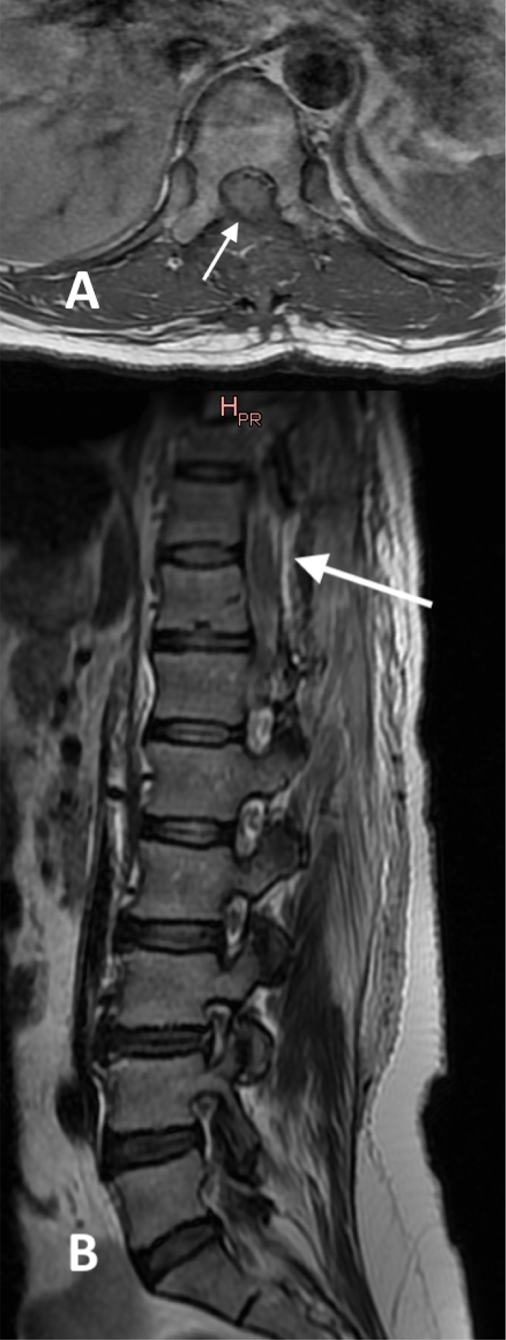 A-T1-axial-MRI-section-and-B-T2-sagittal-MRI-of-the-thoracic-spine-showing